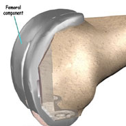 femoral component,knee replacement india,knee replacement delhi,knee replacment india